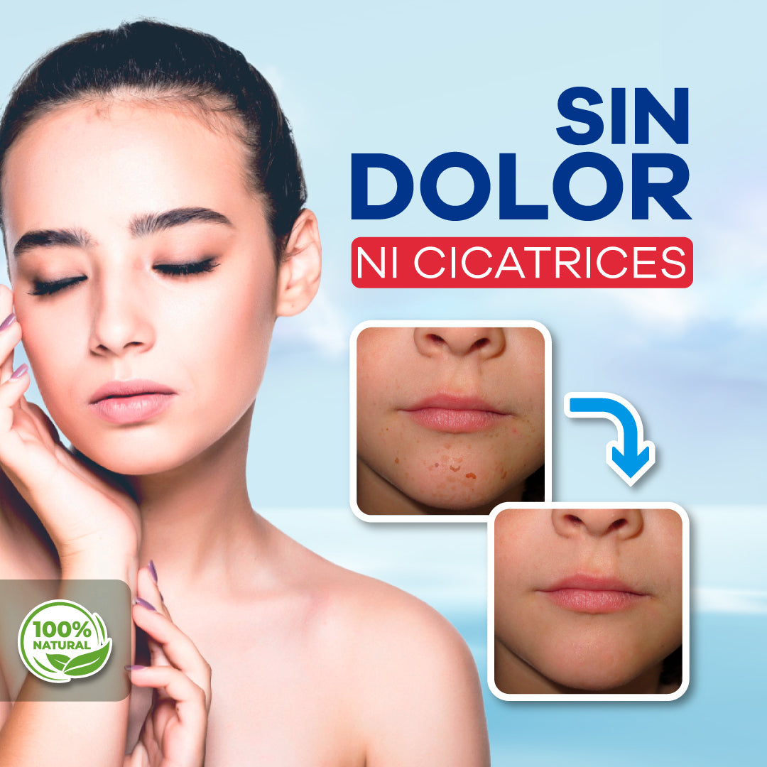 WART REMOVER™ - Elimina Verrugas y Lunares en la piel